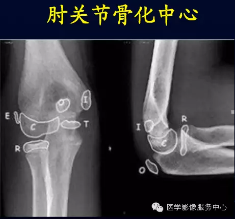 【今日征象】不要小瞧骨折的诊断--歪戴帽征及八字征