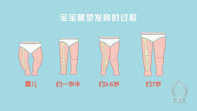 婴幼儿有“O型腿”或“内八字”需要治疗吗？不少家长急坏了