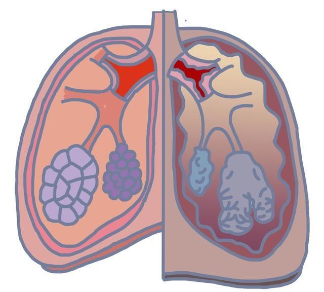 老年性肺大泡注意什么_老年肺大泡_老年人得了肺大泡能活多久